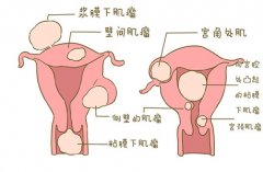 什么是宫腔粘连？