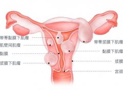子宫癌临床表现
