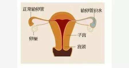 输卵管积水可以做试管婴儿吗?