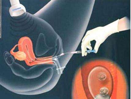 试管婴儿取卵疼吗?