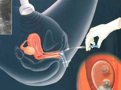 做试管婴儿如何取卵?